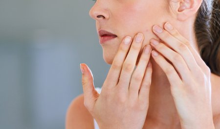 Photoderm acne scraching skin