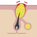 Cutibacterium acnes